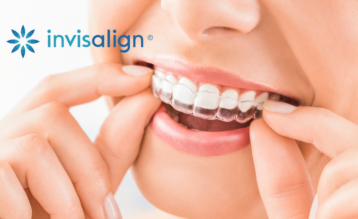 Orthodontie invisible Invisalign